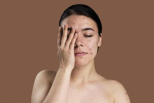 Peaux acnéiques : les cosmétiques naturels sont-ils adaptés ?